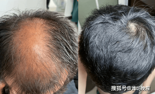 生发产品,哪个值得买?2025测评:值得买的都在这!